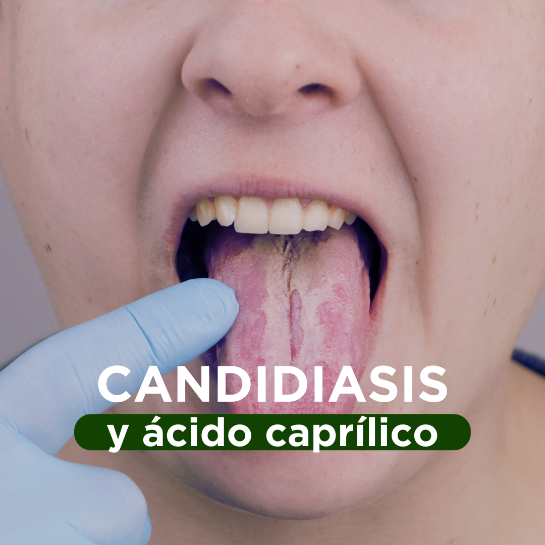 Candidiasis y tratamiento con Ácido Caprílico